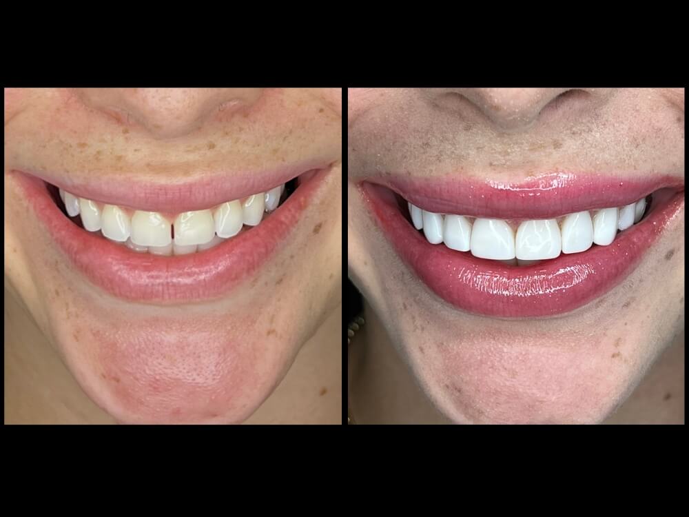 Facetas e Lentes de Contato Dental - Dr. Humberto Berwanger - Cirurgião-dentista 19 01