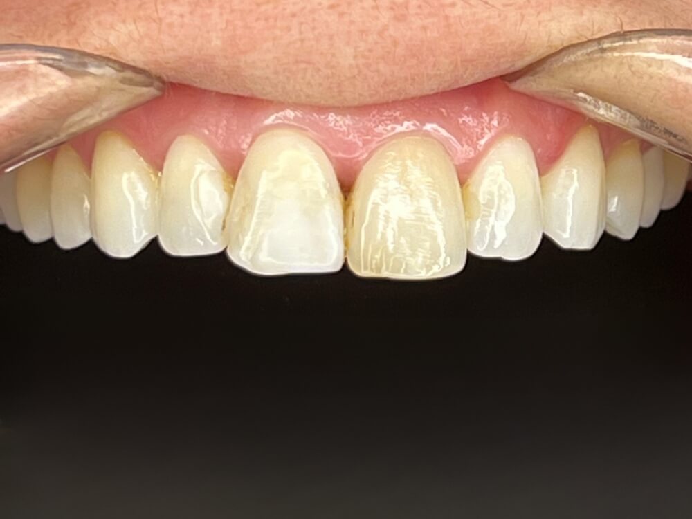 Facetas e Lentes de Contato Dental - Dr. Humberto Berwanger - Cirurgião-dentista 9 02 2