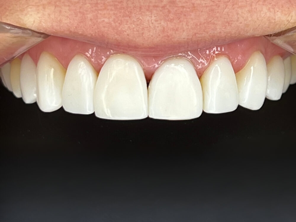 Facetas e Lentes de Contato Dental - Dr. Humberto Berwanger - Cirurgião-dentista 10 02 3