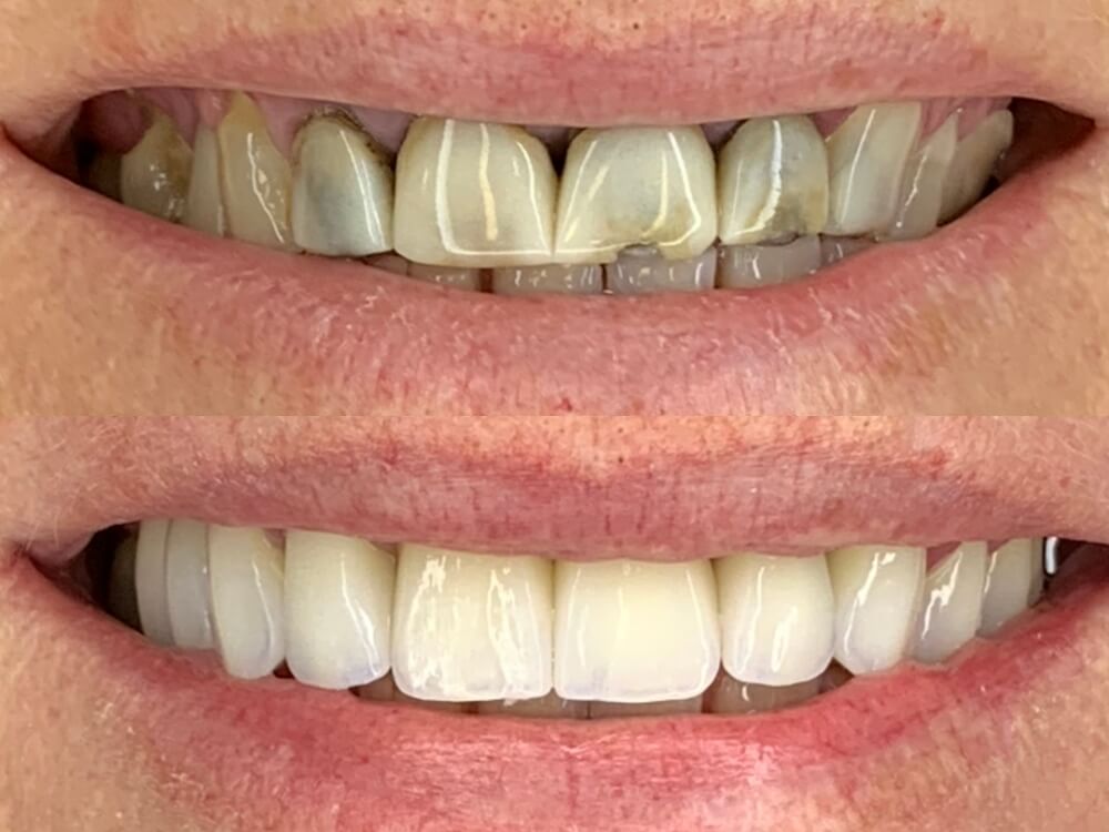 Facetas e Lentes de Contato Dental - Dr. Humberto Berwanger - Cirurgião-dentista 20 04 4