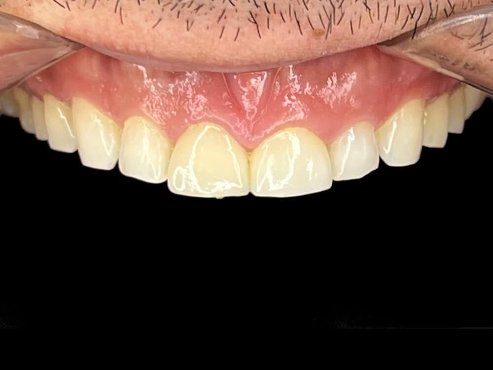 Facetas e Lentes de Contato Dental - Dr. Humberto Berwanger - Cirurgião-dentista 13 06 2