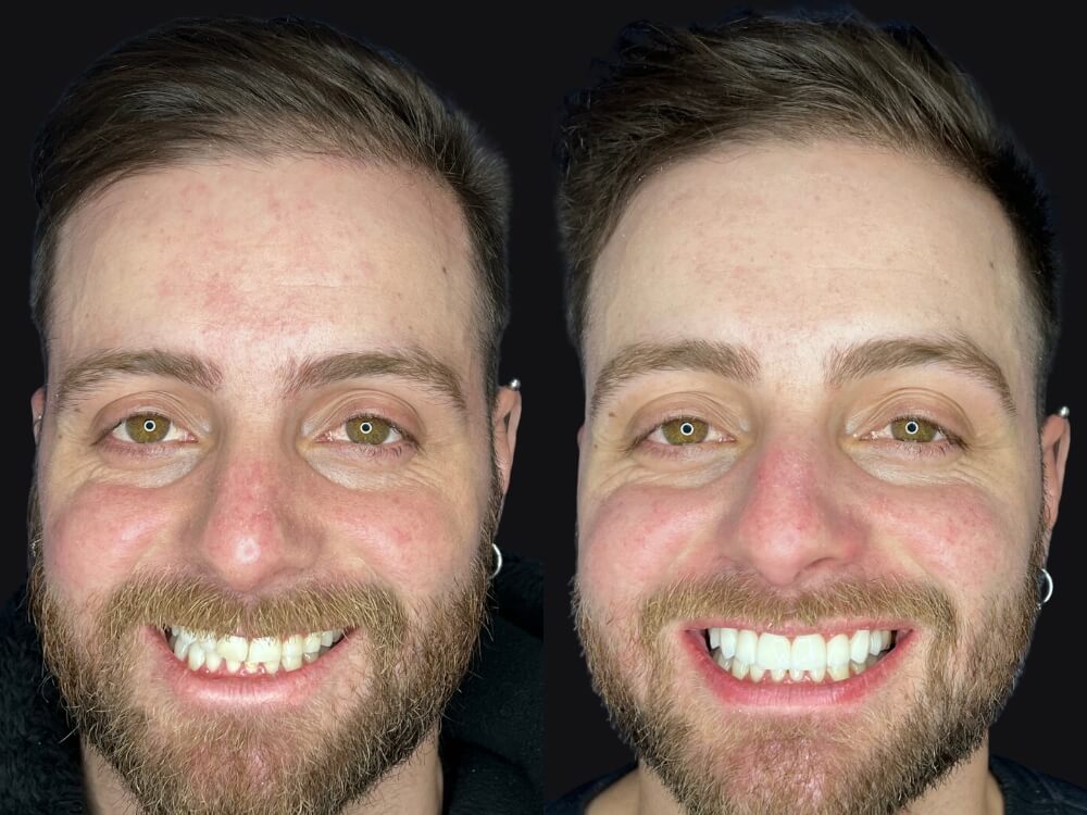 Facetas e Lentes de Contato Dental - Dr. Humberto Berwanger - Cirurgião-dentista 17 07 13