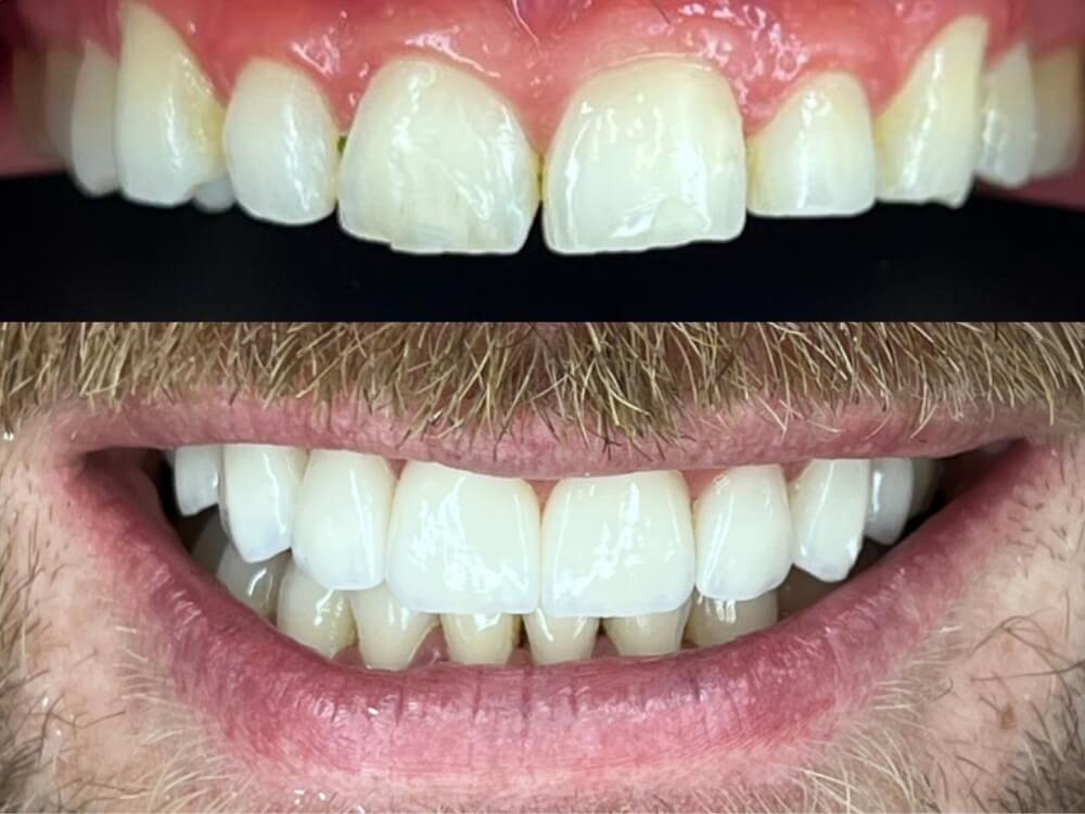 Facetas e Lentes de Contato Dental - Dr. Humberto Berwanger - Cirurgião-dentista 18 07 16