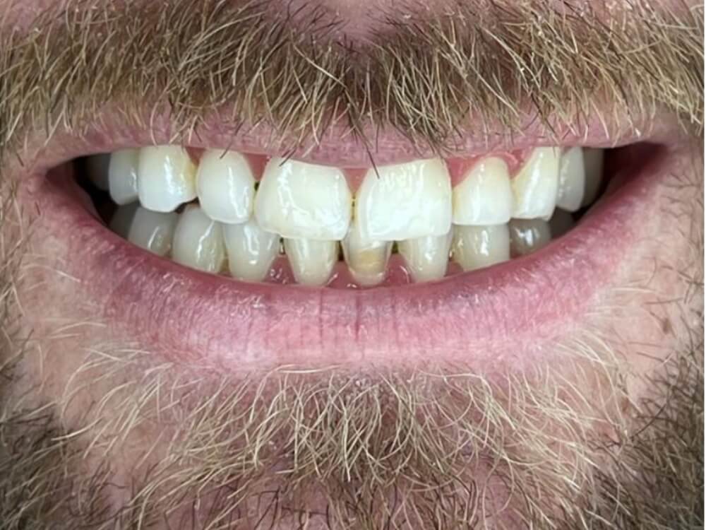 Facetas e Lentes de Contato Dental - Dr. Humberto Berwanger - Cirurgião-dentista 11 07 8 1