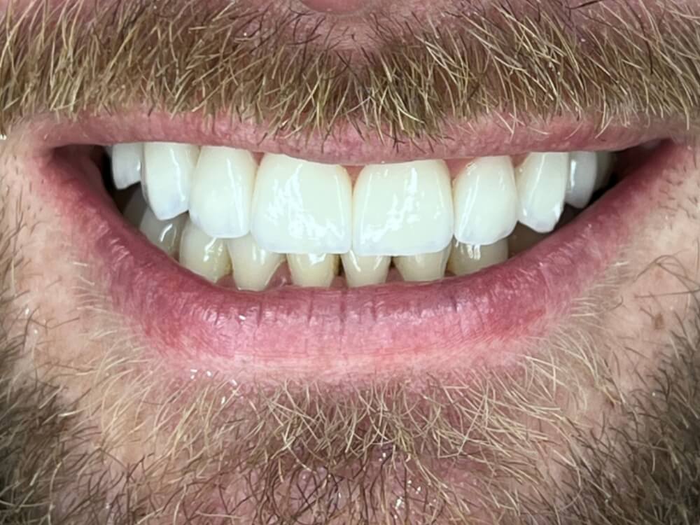 Facetas e Lentes de Contato Dental - Dr. Humberto Berwanger - Cirurgião-dentista 12 07 9 1