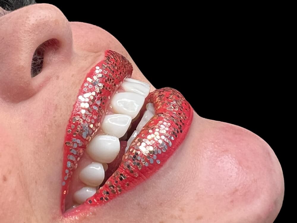 Facetas e Lentes de Contato Dental - Dr. Humberto Berwanger - Cirurgião-dentista 15 5