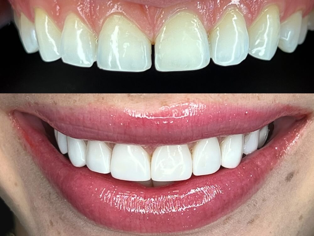 Facetas e Lentes de Contato Dental - Dr. Humberto Berwanger - Cirurgião-dentista 1 facetas resina 01 1