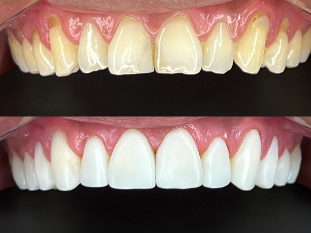 Facetas e Lentes de Contato Dental - Dr. Humberto Berwanger - Cirurgião-dentista 21 facetas resina 03 4