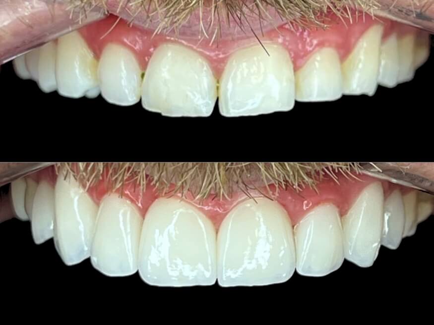 Facetas e Lentes de Contato Dental - Dr. Humberto Berwanger - Cirurgião-dentista 3 lentes em porcelana