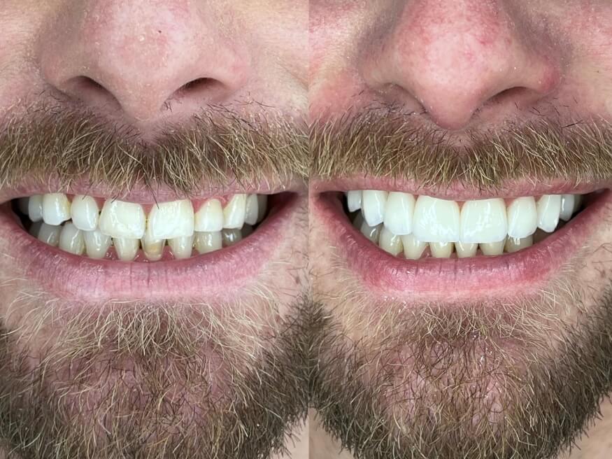 Facetas e Lentes de Contato Dental - Dr. Humberto Berwanger - Cirurgião-dentista 2 lentes porcelana 03