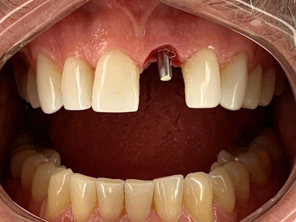 Implantes Dentários - Dr. Humberto Berwanger - Cirurgião-dentista 6 55