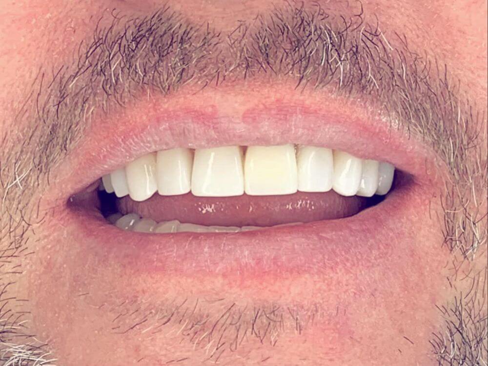 Implantes Dentários - Dr. Humberto Berwanger - Cirurgião-dentista 14 56