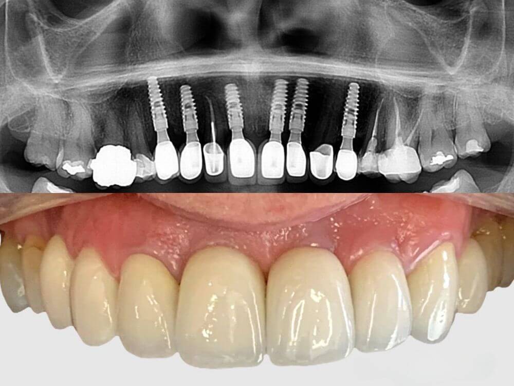 Implantes Dentários - Dr. Humberto Berwanger - Cirurgião-dentista 11 57