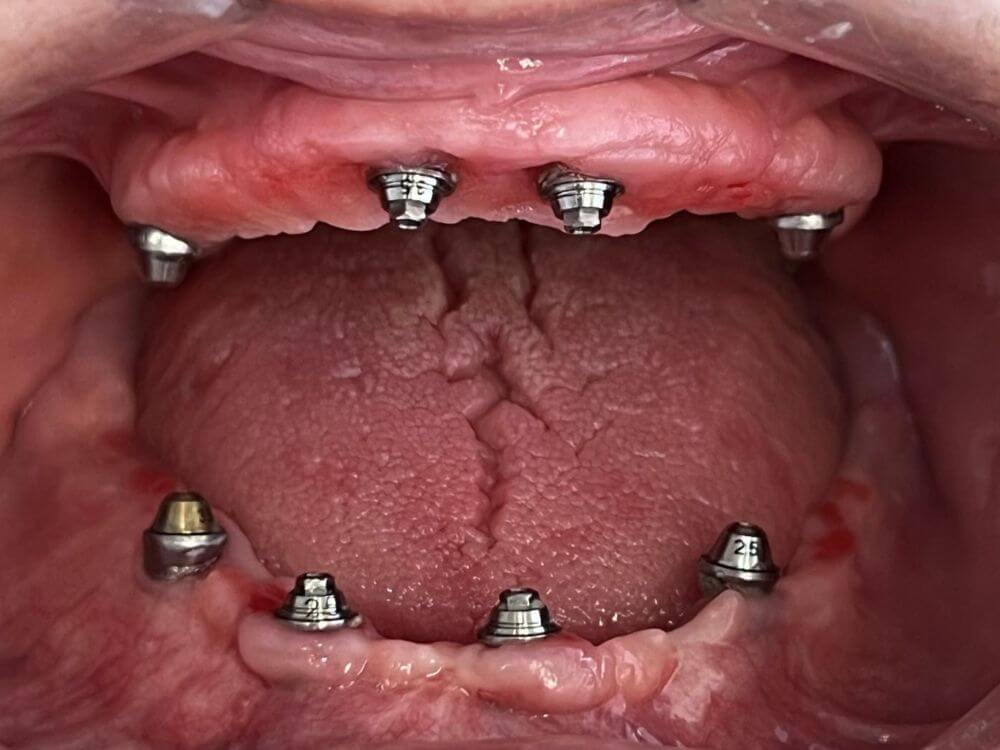 Implantes Dentários - Dr. Humberto Berwanger - Cirurgião-dentista 15 59