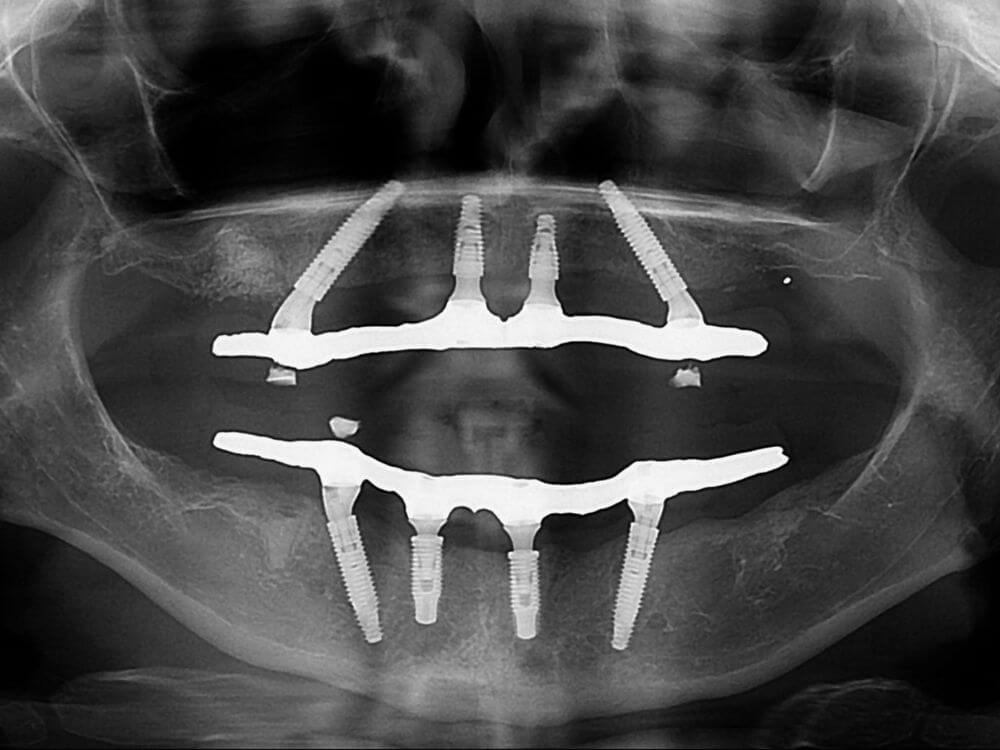 Implantes Dentários - Dr. Humberto Berwanger - Cirurgião-dentista 7 60