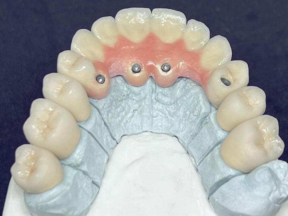 Implantes Dentários - Dr. Humberto Berwanger - Cirurgião-dentista 25 62
