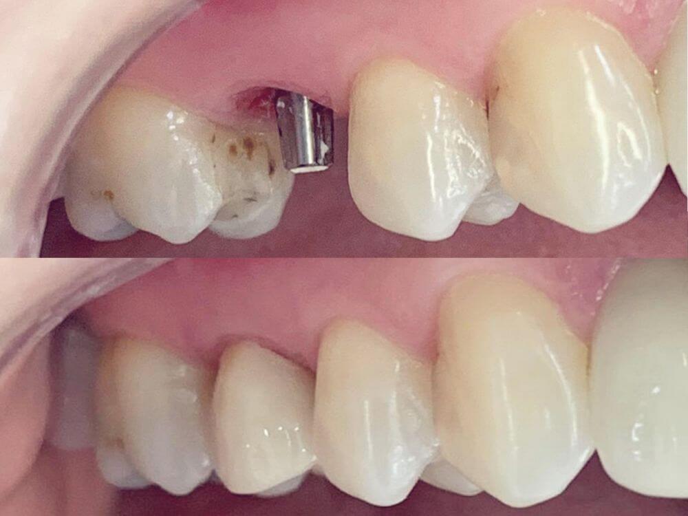 Implantes Dentários - Dr. Humberto Berwanger - Cirurgião-dentista 8 63