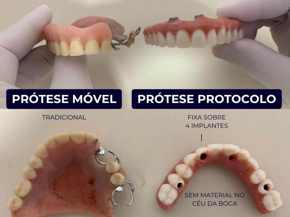 Implantes Dentários - Dr. Humberto Berwanger - Cirurgião-dentista 4 66 1