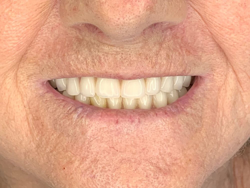 Implantes Dentários - Dr. Humberto Berwanger - Cirurgião-dentista 19 77