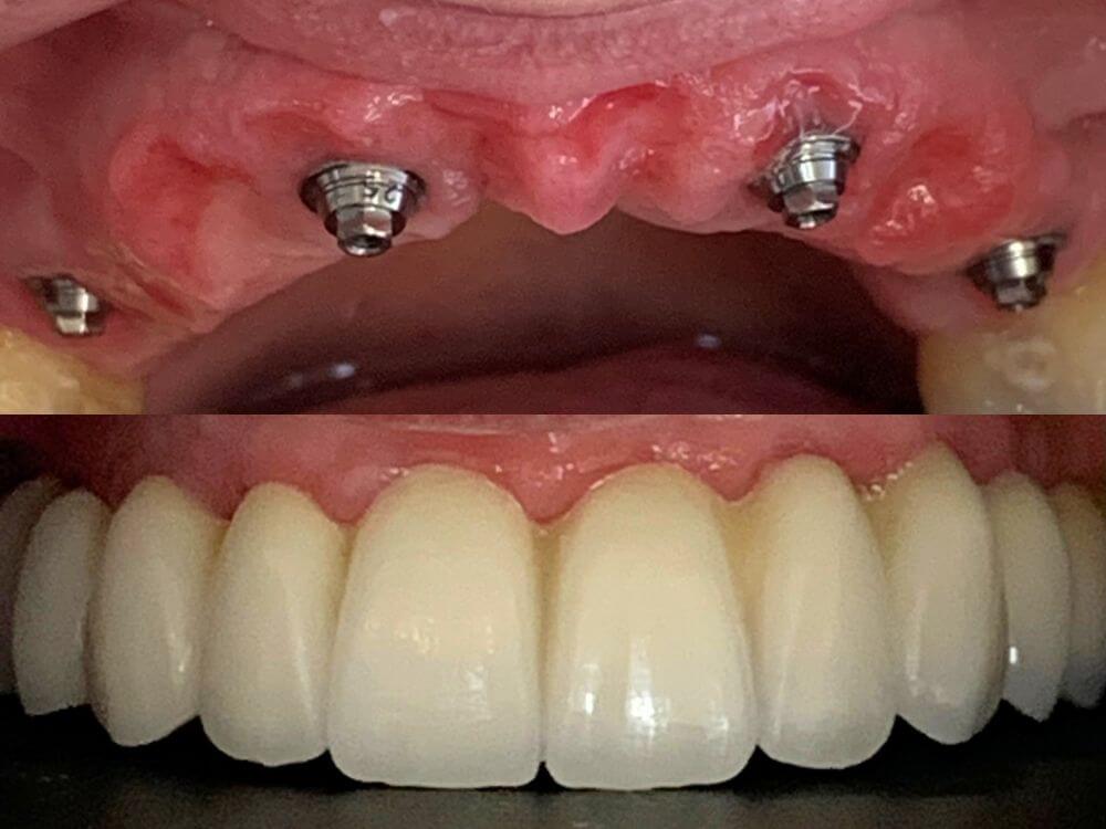 Implantes Dentários - Dr. Humberto Berwanger - Cirurgião-dentista 20 79