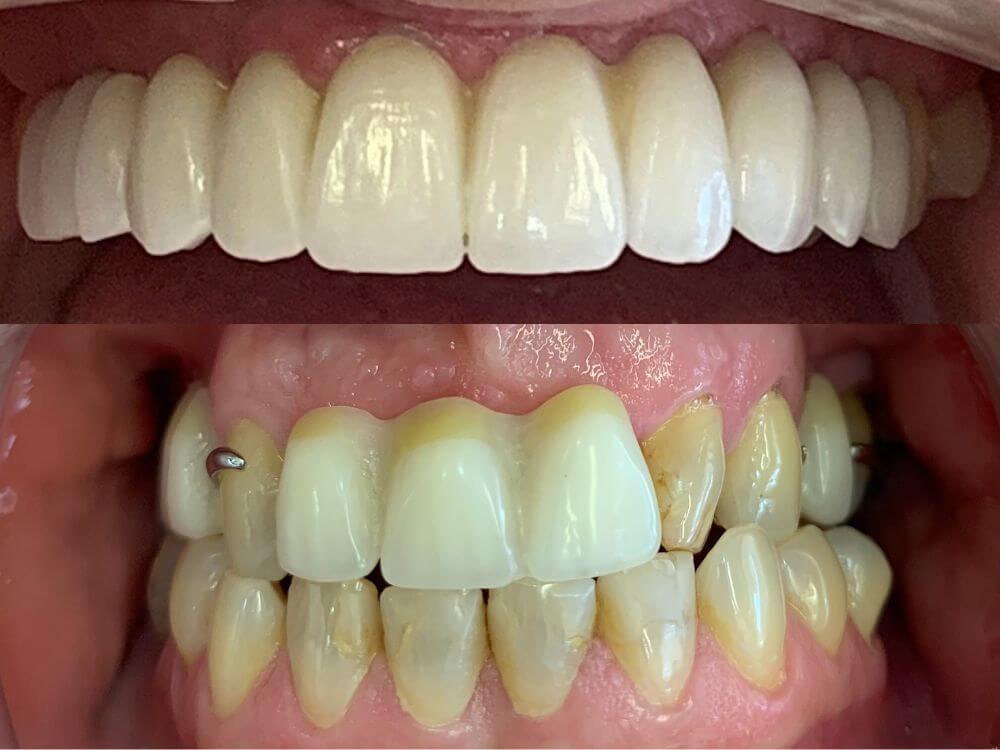 Implantes Dentários - Dr. Humberto Berwanger - Cirurgião-dentista 26 80