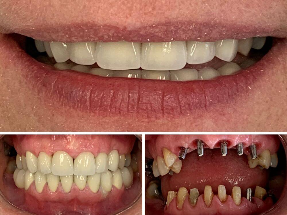 Implantes Dentários - Dr. Humberto Berwanger - Cirurgião-dentista 22 82