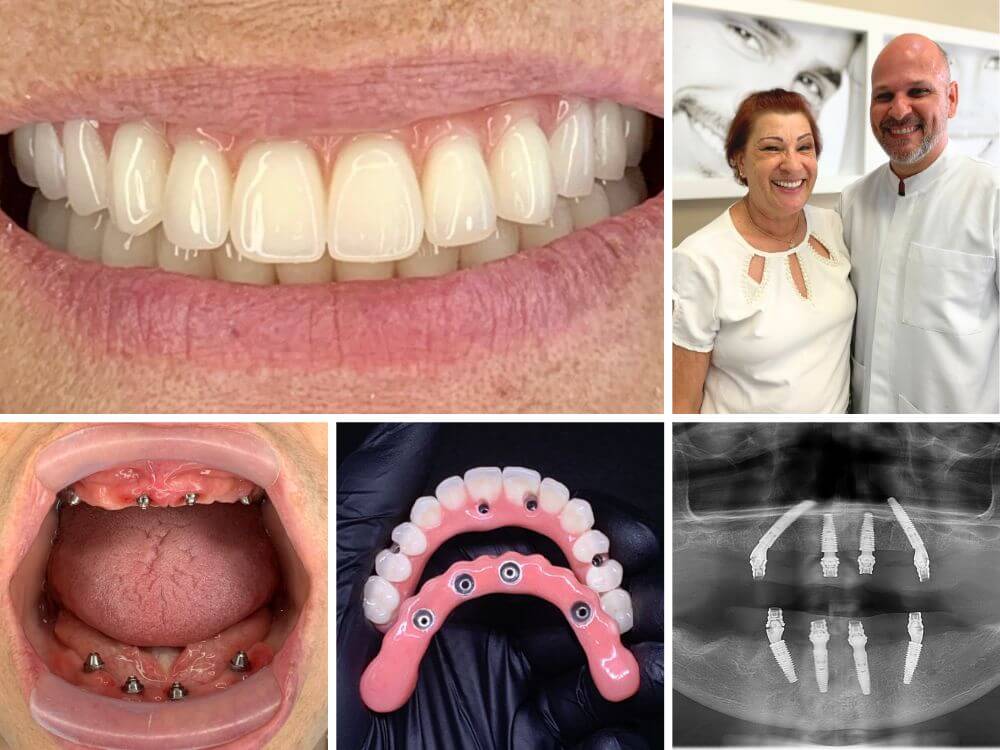 Implantes Dentários - Dr. Humberto Berwanger - Cirurgião-dentista 3 83